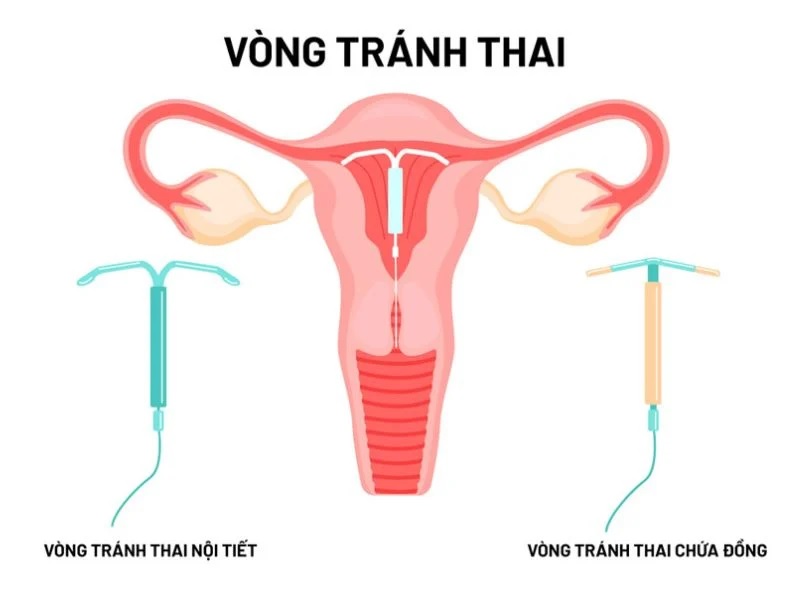 Đặt vòng tránh thai có đau không? tìm hiểu quy trình và lưu ý dat-vong-tranh-thai