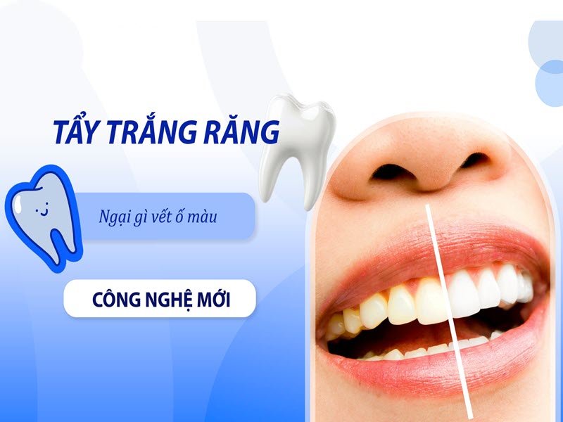 dịch-vu-rang-ham-mat-1