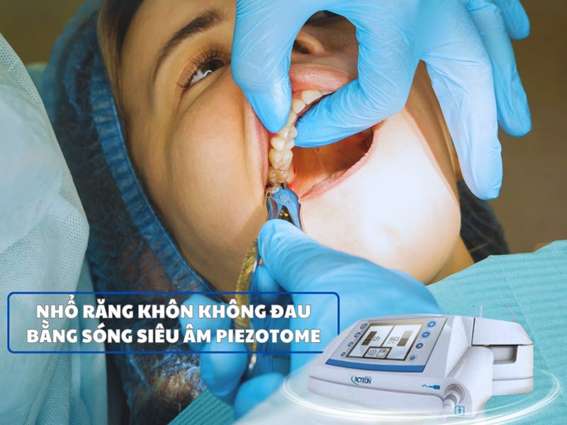 Nhổ răng khôn có đau không? Nên nhổ khi nào? nho-rang-khon-tai-benh-vien-nga-tu-ho