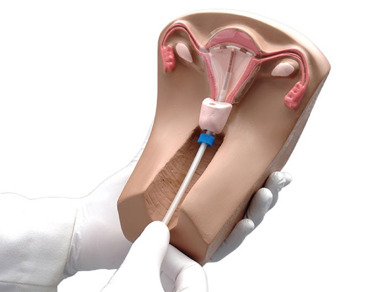 Đặt vòng tránh thai có đau không? tìm hiểu quy trình và lưu ý quy-trinh-dat-vong-tranh-thai