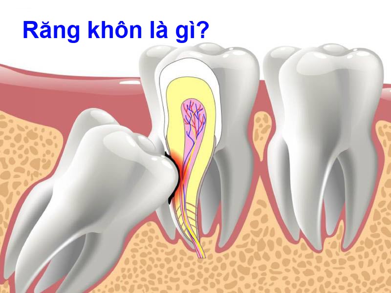 Nhổ răng khôn có đau không? Nên nhổ khi nào? rang-khon-la-gi