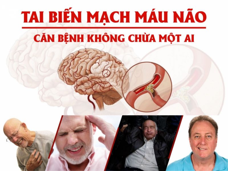 Vật lý trị liệu sau tai biến mạch máu não vì sao quan trọng? vat-ly-tri-lieu-sau-tai-bien-mach-mau-nao