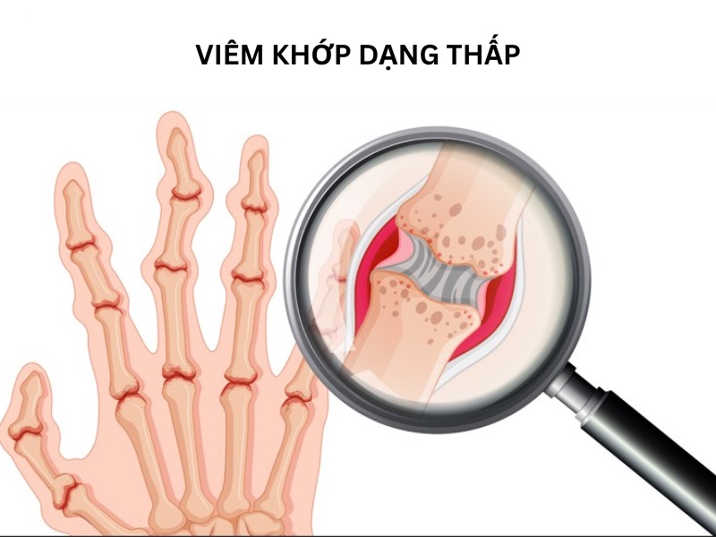 benh-viem-khop-dang-thap