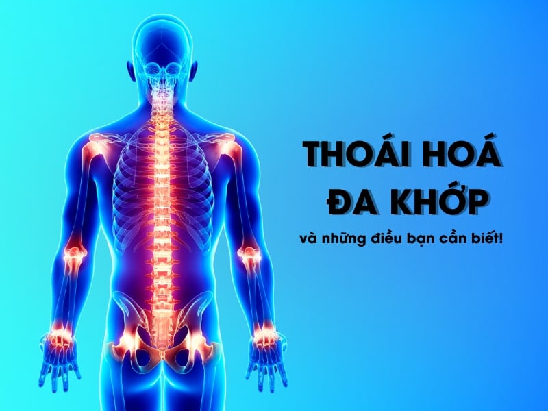 Thoái hóa khớp: Nguyên nhân, triệu chứng và phương pháp điều trị nguyen-nhan-va-trieu-trung-cua-thoai-hoa-da-khop