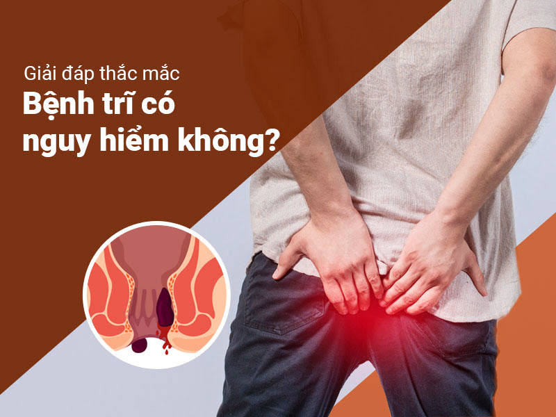Bệnh trĩ – Nguyên nhân, triệu chứng và phương pháp điều trị hiệu quả benh-tri-co-nguy-hiem-khong