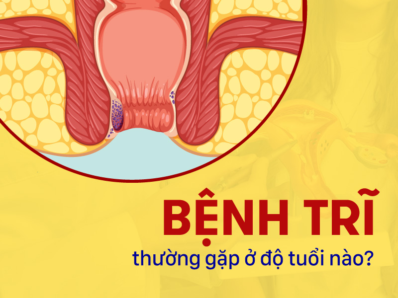 Bệnh trĩ – Nguyên nhân, triệu chứng và phương pháp điều trị hiệu quả benh-tri-thuong-gap-o-do-tuoi-na