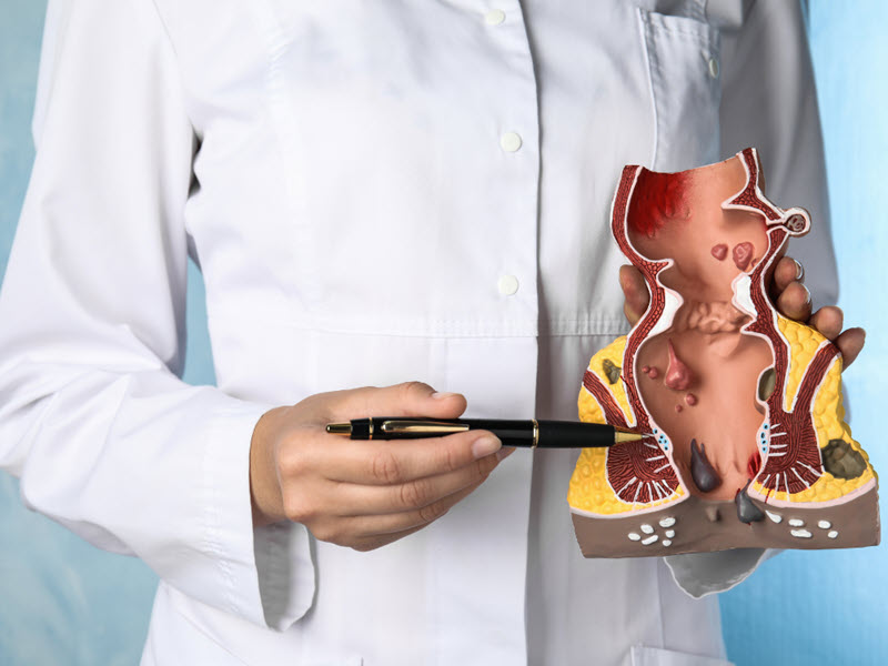 Điều trị bệnh trĩ không phẫu thuật dieu-tri-benh-tri-khong-phau-thuat-1