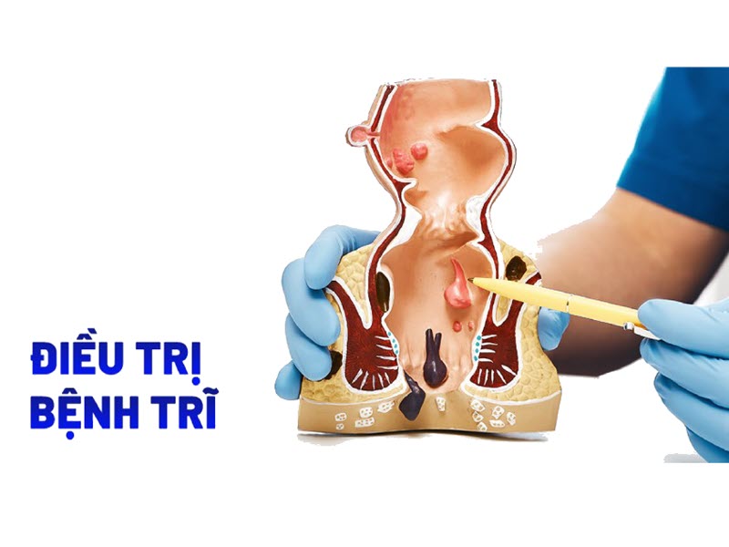 Điều trị bệnh trĩ không phẫu thuật dieu-tri-benh-tri-khong-phau-thuat