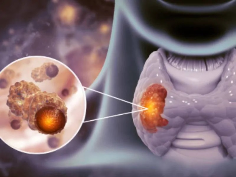 kham-va-dieu-tri-benh-tuyen-giap-tai-bac-ninh-3