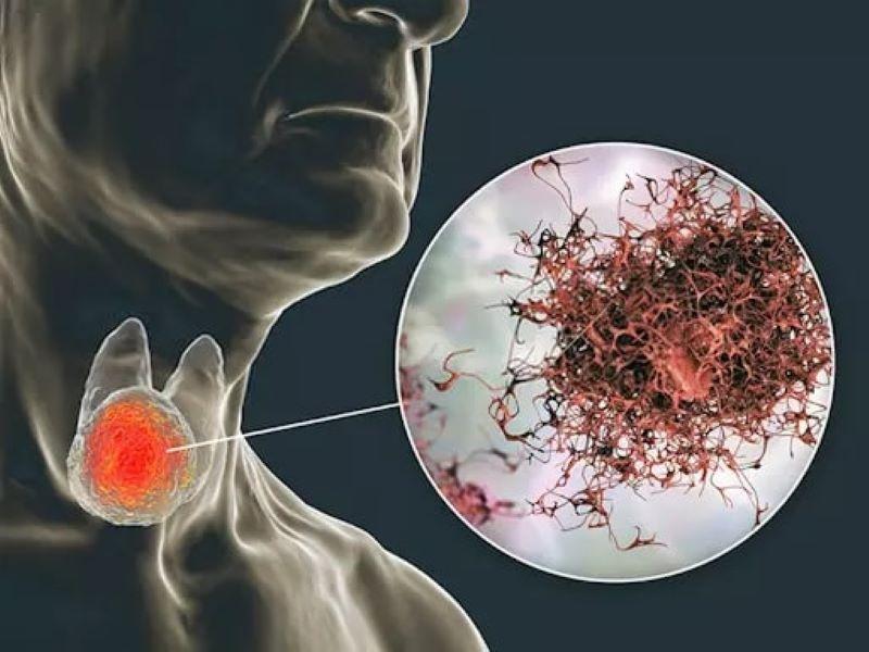 kham-va-dieu-tri-benh-tuyen-giap-tai-bac-ninh