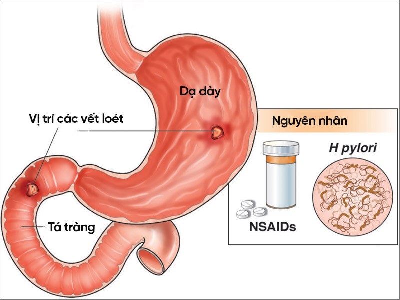 kham-va-dieu-tri-viem-loet-da-day-ta-trang