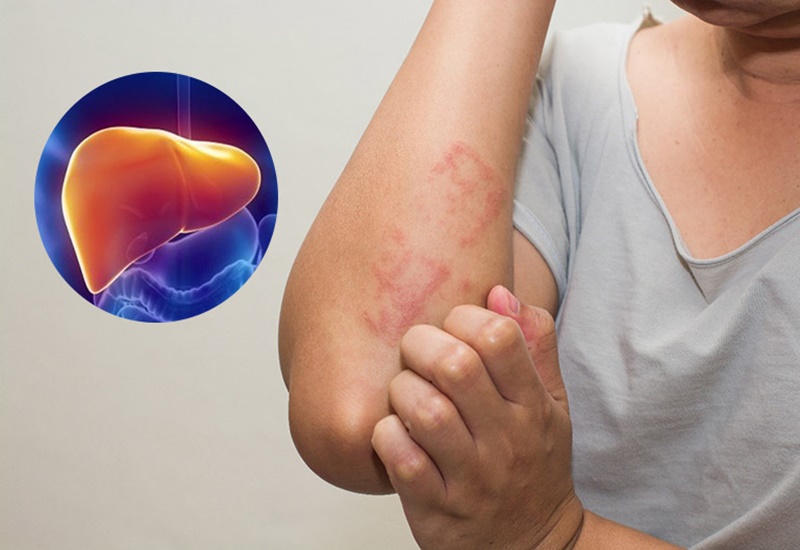 Phát hiện sớm bệnh gan qua xét nghiệm máu – chìa khóa bảo vệ sức khỏe lá gan benh-gan-co-nguy-hiem-khong