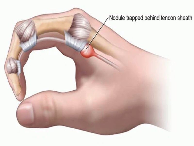 Bệnh ngón tay lò xo - viêm gân gấp: Nguyên nhân, triệu chứng và hướng điều trị hiệu quả benh-ngon-tay-lo-xo-viem-gan-gap