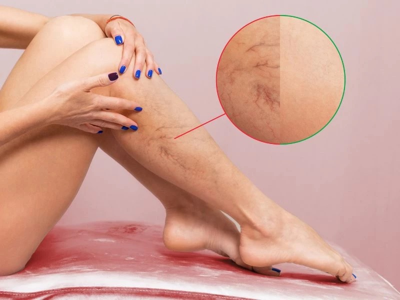 Giãn tĩnh mạch chi dưới: Nguyên nhân, triệu chứng và điều trị hiệu quả bi-gian-tinh-mach-chi-duoi-phai-lam-sao