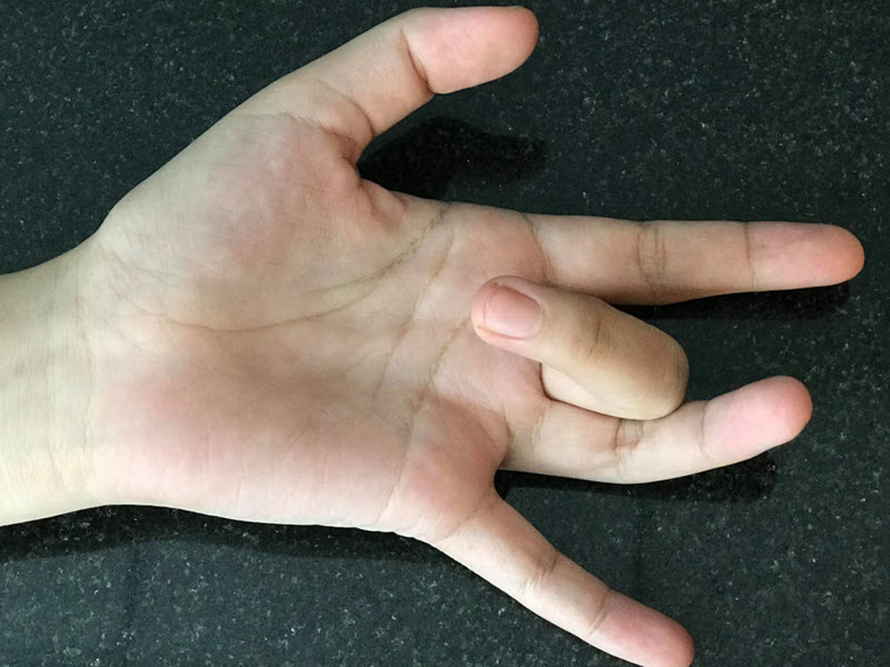 Bệnh ngón tay lò xo - viêm gân gấp: Nguyên nhân, triệu chứng và hướng điều trị hiệu quả bieu-hien-benh-ngon-tay-lo-xo-viem-gan-gap