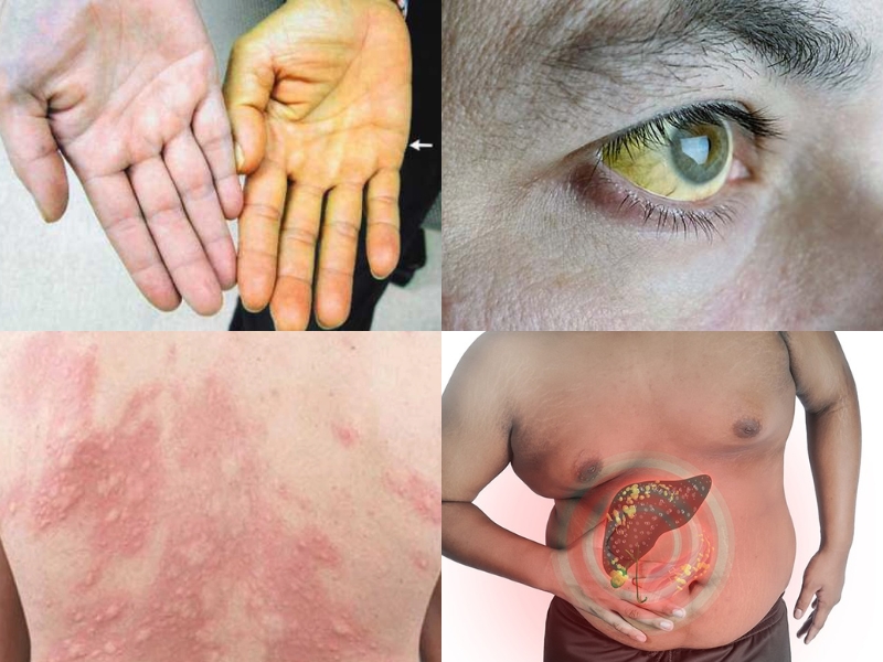 Phát hiện sớm bệnh gan qua xét nghiệm máu – chìa khóa bảo vệ sức khỏe lá gan bieu-hien-cua-benh-gan