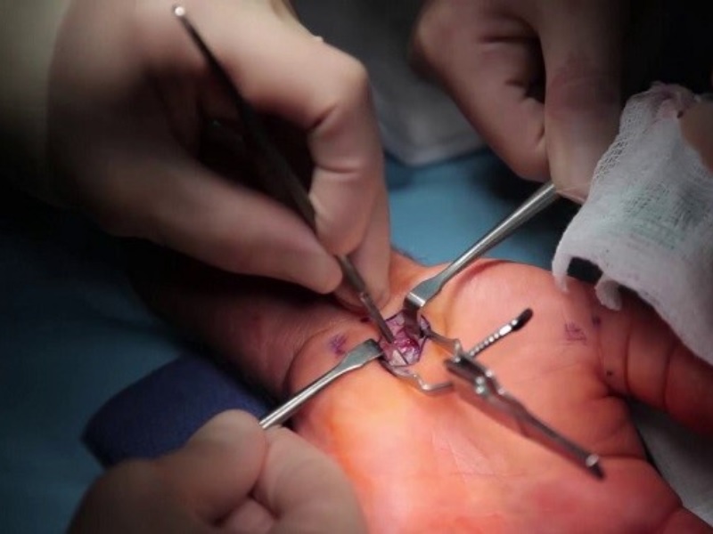 Hội chứng ống cổ tay nguyên nhân triệu chứng và hướng điều trị hiệu quả cach-dieu-tri-hoi-chung-ong-co-tay