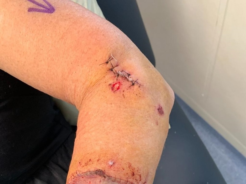 nguoi-bi-cho-meo-can-rat-de-bi-mac-benh-dai