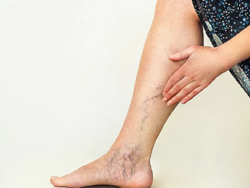 Giãn tĩnh mạch chi dưới: Nguyên nhân, triệu chứng và điều trị hiệu quả nguyen-nhan-gian-tinh-mach-chi-duoi