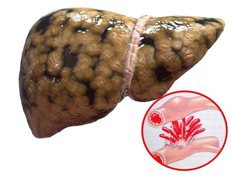 Phát hiện sớm bệnh gan qua xét nghiệm máu – chìa khóa bảo vệ sức khỏe lá gan phat-hien-som-benh-gan-qua-xet-nghiem-mau-1