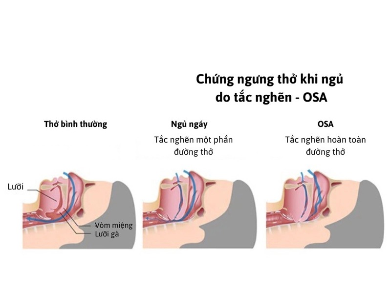 dieu-tri-hoi-chung-ngung-tho-khi-ngu