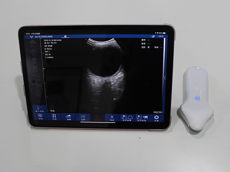 Siêu âm Doppler là gì? Khi nào cần thực hiện và có quan trọng không? may-sieu-am-doppler