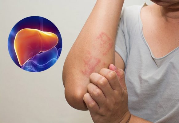 benh-gan-co-nguy-hiem-khong