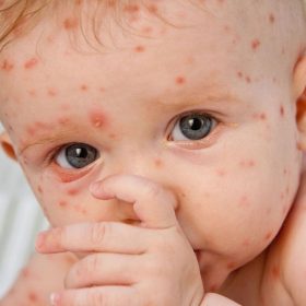 nguyen-nhan-trieu-chung-benh-thuy-dau