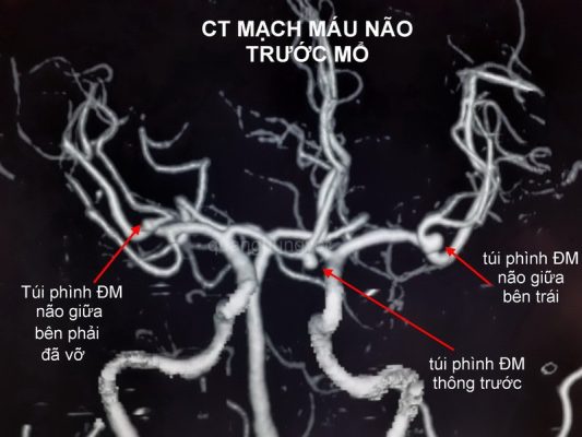 tui-phinh-mach-mau-nao-la-gi
